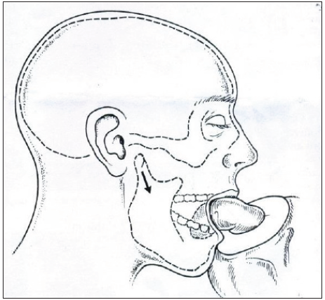 Condylar Head distracted laterally to stretch lateral capsule, black arrow indicates Condylar Head distracted laterally.