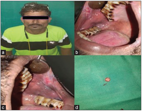 (a) Patient straight profile, (b & c) Erythematous patch with grayish white specks seen on the right and left buccal mucosa, (d) Biopsied tissue.
