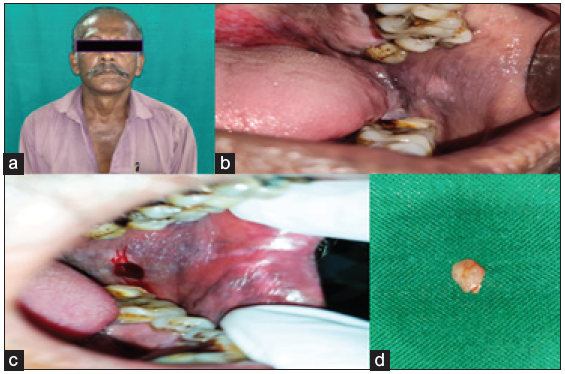 (a) patient straight profile, (b) elevated grayish white hyperkeratotic patch, which was seen extending 1 cm behind the retro-commissure of the lip anteriorly to the retromolar pad region posteriorly, (c) biopsy site, (d) Biopsied tissue.