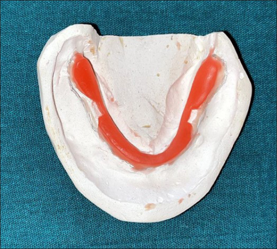 Double-thickness wax spacer adaptation (mandibular).