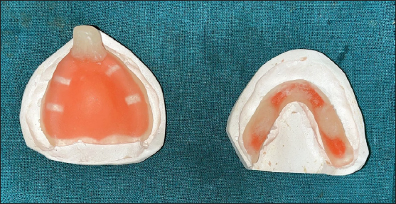 Custom trays (maxillary and mandibular).