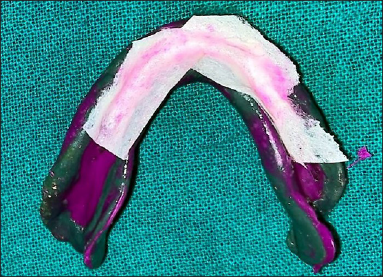 Placement of tissue (blotting) paper over the mandibular anterior region of the impression surface.