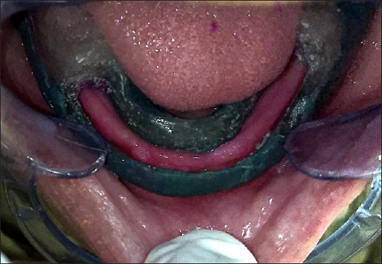Window preparation in the custom tray (Evaluation of the tray inside the patient’s mouth).