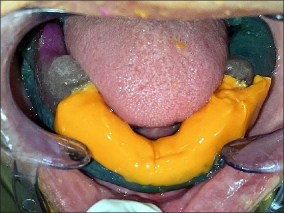 Final impression of the flabby ridge (Evaluation in patient’s mouth).