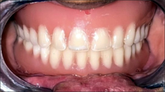 Removable complete dentures – in patient’s mouth.