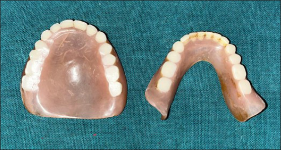 Previous removable dental prostheses of the patient (Occlusal surface).