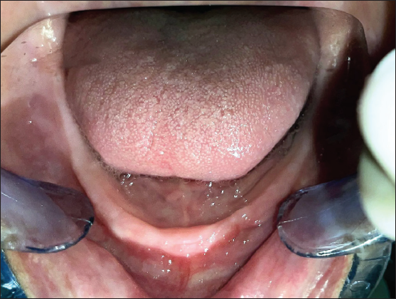 Edentulous mandibular residual alveolar ridge.