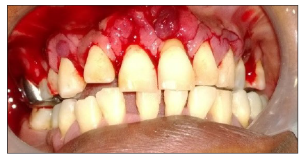 External bevel gingivectomy incision.