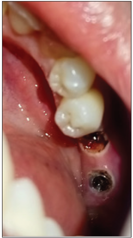 Implant sites are exposed using an electrosurgical unit (immediate post-op) wrt 46 and a doide laser wrt 47 [C 1].