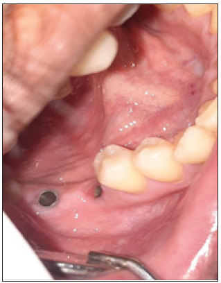 Implant sites exposed using electrosurgical unit (after 14 days) wrt 46 and diode laser wrt 47 [C 1].