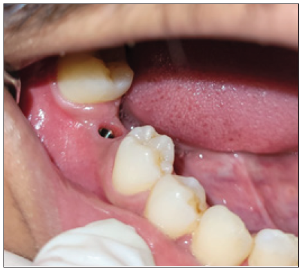 Implant site exposed using tissue punch biopsy (after 14 days) wrt 46 [C 2].