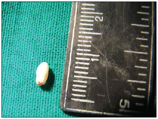 Presence of tuberculate and underdeveloped root.