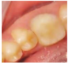 After composite onlay cementation.