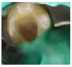 Access cavity after sealing the canal orifices with glass-ionomer-cement, followed by the placement of flowable composite, as a base for the indirect composite onlay and cavity preparation.